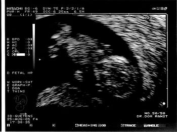 Early ultrasound
